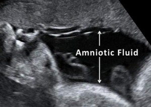 AmnioticFluid