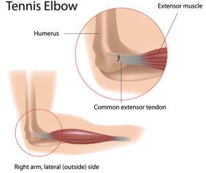 PRP for Tennis Elbow